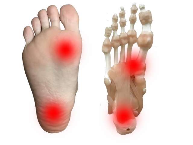 足の底に痛みがある『足底腱膜炎について』
